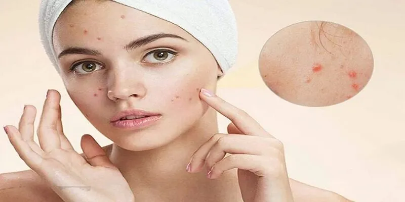 Liệu Trình Chăm Sóc Da Mụn – Cần Biết Trước Khi Chọn Spa
