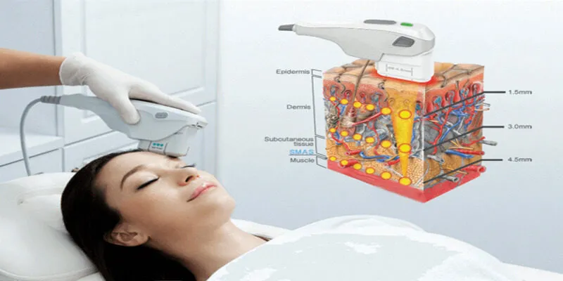 Nâng cơ HIFU có thật sự hiệu quả không? Tác động rõ rệt lên da
