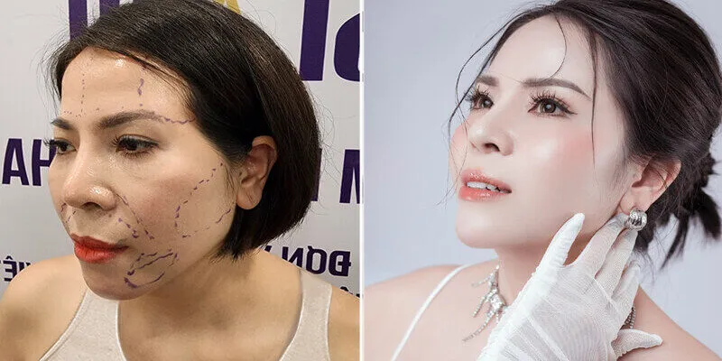 So sánh tiêm filler và cấy mỡ tự thân về thời gian duy trì